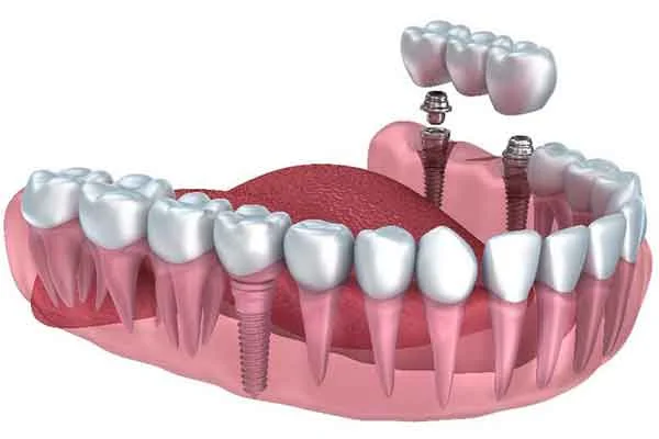 All Smiles Multispeciality Dental Spa photo 4
