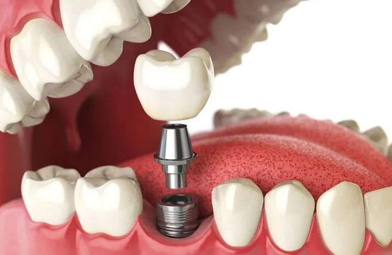 ASPEN DENTAL POLYCLINIC - L.L.C photo 3