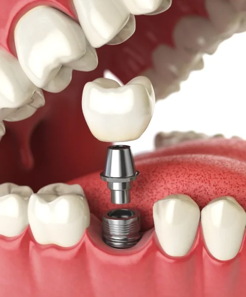 DR SHOUKU DENTAL & IMPLANT CLINIC L.L.C photo 7